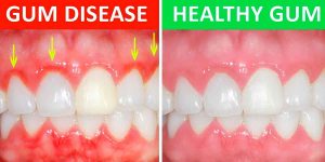 Periodontal Disease – You Might Have it and Not Even Know It